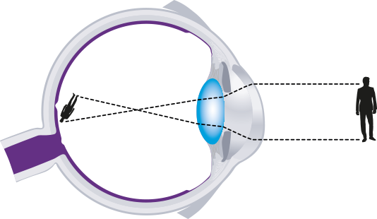 Astigmatism